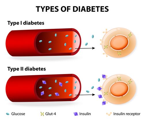 Gejala Diabetes - Tipe 1 Vs Tipe 2 Semakin cepat Anda menangani kondisi